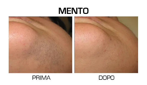 mento